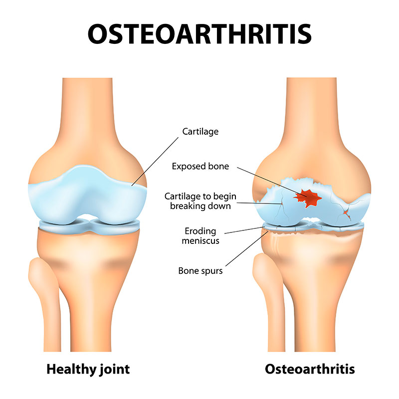 Osteoarthritis Treatment in Ayurveda